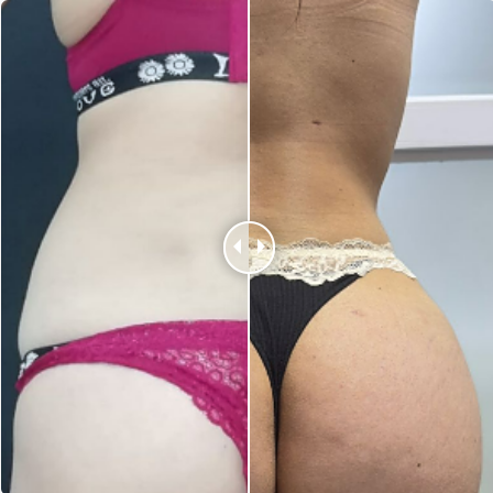 Aumento mamario antes y después - Paciente Chile